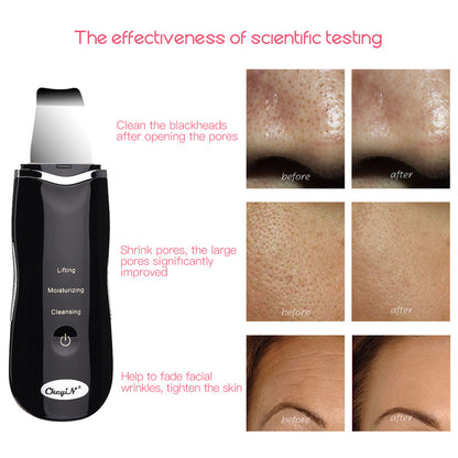 Ultrasonic Peeling Skin Scrubber - 3-in-1 Rechargeable Facial Cleansing Shovel, Deep Pore Exfoliator & Microcurrent Skin Firming Device
